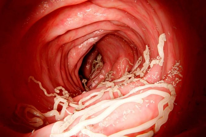Ascaris lumbricoides en colon